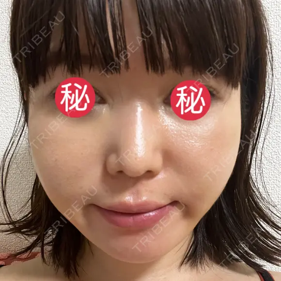 糸リフト / 脂肪吸引（顔） / メーラーファット除去 BLINC CLINIC （ブリンク クリニック） DAY 6 メイン用