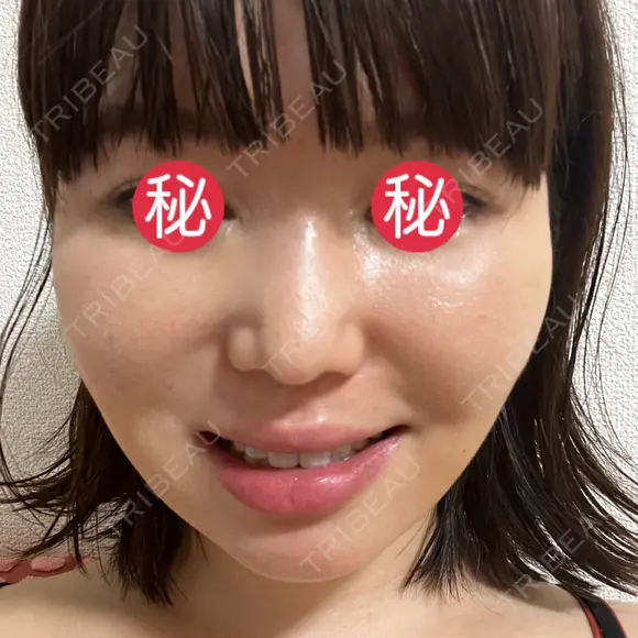 糸リフト / 脂肪吸引（顔） / メーラーファット除去 BLINC CLINIC （ブリンク クリニック） DAY 6 メイン用