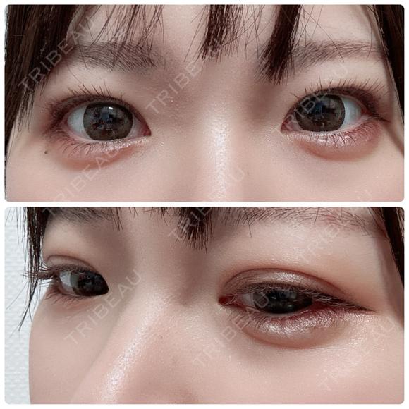 ヒアルロン酸注入（涙袋） NARU Beauty Clinic 【ナルクリ】 AFTER メイン用