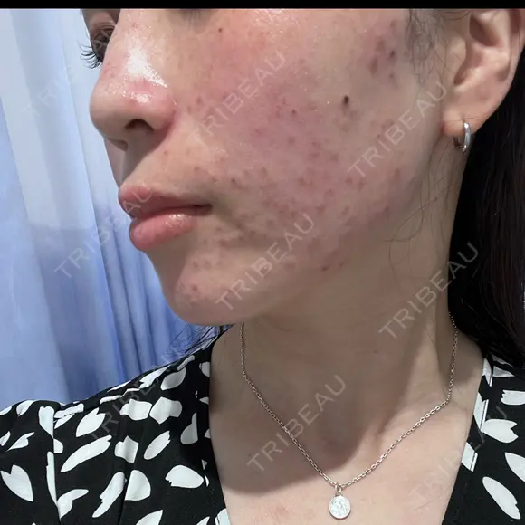 シミ取りレーザー / ピコレーザートーニング（美白・肝斑） PRISM Beauty Clinic 町田院 DAY 0 メイン用