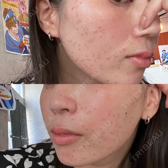 シミ取りレーザー / ピコレーザートーニング（美白・肝斑） PRISM Beauty Clinic 町田院 DAY 0 メイン用