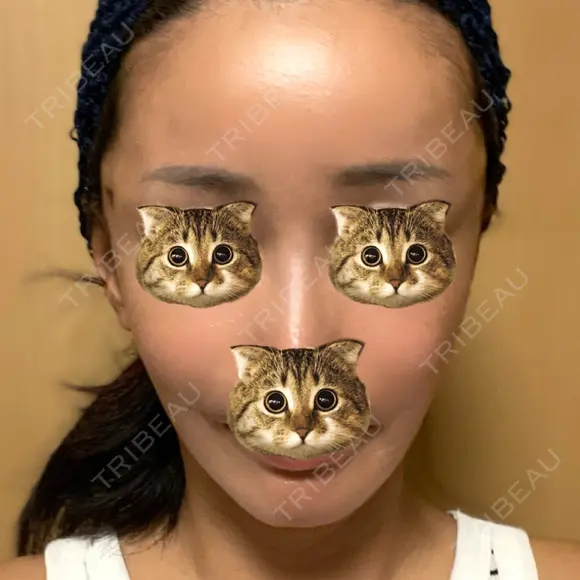 切開リフト 東京エビスクリニック AFTER メイン用