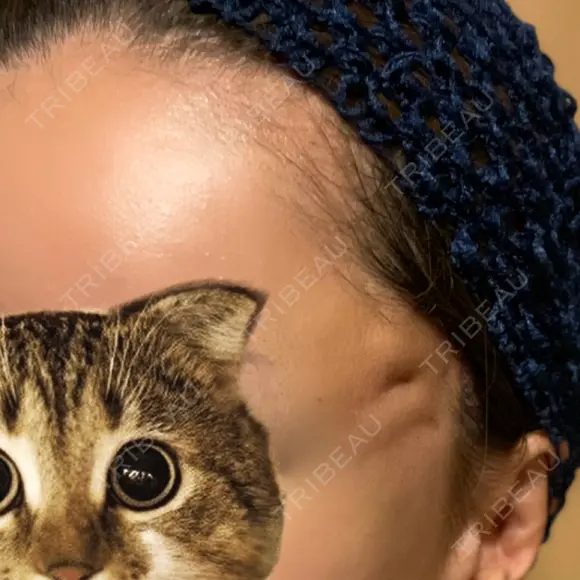 切開リフト 東京エビスクリニック DAY 10 メイン用