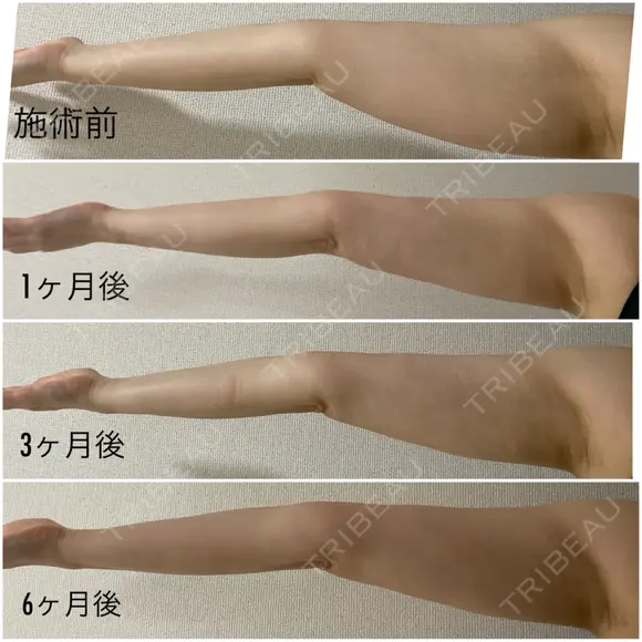 脂肪吸引（二の腕） / 脂肪吸引（肩） Mods Clinic（モッズクリニック） 大阪院 AFTER メイン用