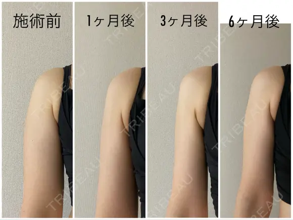 脂肪吸引（二の腕） / 脂肪吸引（肩） Mods Clinic（モッズクリニック） 大阪院 DAY 196 メイン用