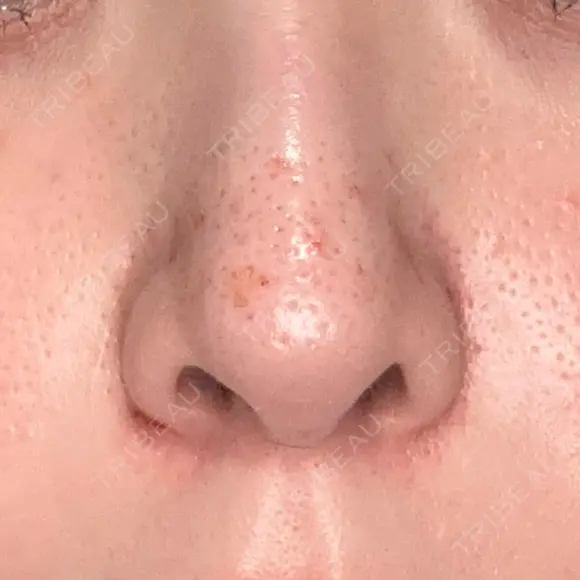 その他（肌） 代官山ウィメンズクリニック DAY 0 メイン用