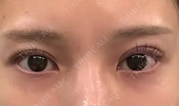 二重切開 WOM CLINIC GINZA （ワム クリニック ギンザ） AFTER メイン用