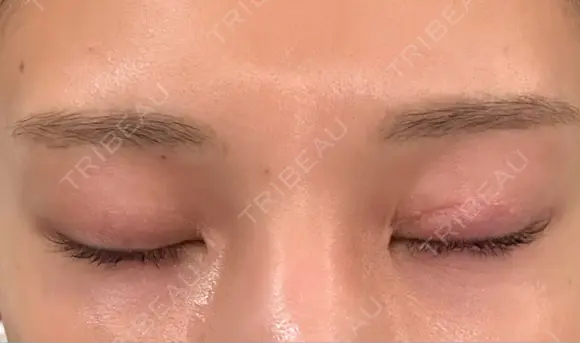 二重切開 WOM CLINIC GINZA （ワム クリニック ギンザ） DAY 80 メイン用