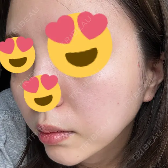 ピコレーザートーニング（美白・肝斑） / ピコフラクショナルレーザー（毛穴・ニキビ跡） BISIN GINZA CLINIC AFTER メイン用