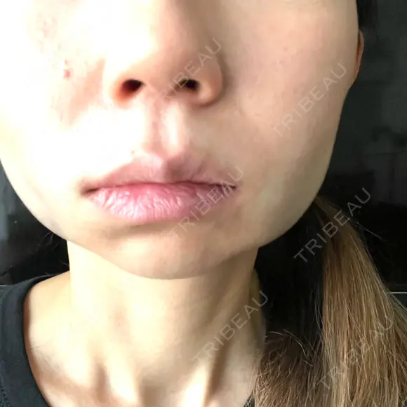 糸リフト / ジョールファット除去 吉祥寺アイビークリニック DAY 0 メイン用