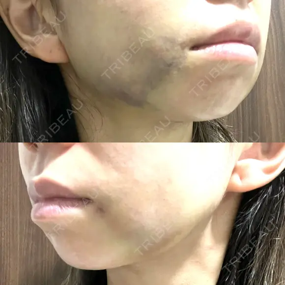 糸リフト / ジョールファット除去 吉祥寺アイビークリニック DAY 2 メイン用