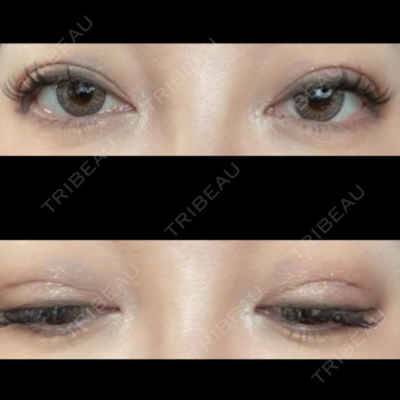 二重埋没 / 上まぶたの脂肪取り ROOTS Clinic DAY 9 メイン用