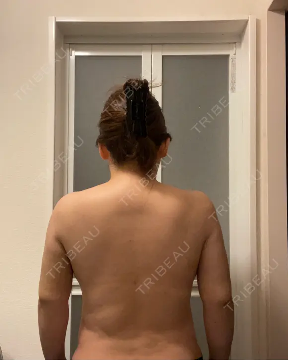 脂肪吸引（顔） / 脂肪吸引（二の腕） / 脂肪吸引（腰） / 脂肪吸引（背中） / 脂肪吸引（肩） Mods Clinic（モッズクリニック） 東京院 DAY 30 メイン用