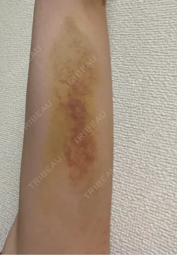 脂肪冷却（二の腕） LE CLINIC DAY 6 メイン用