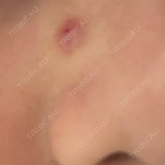 ほくろ・いぼ除去レーザー（肌） 美容皮膚科エルムクリニック 大阪院 DAY 6 メイン用