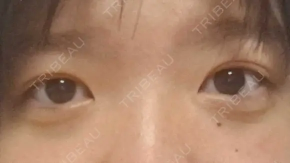 二重埋没 ルラ美容クリニック 渋谷本院 AFTER メイン用