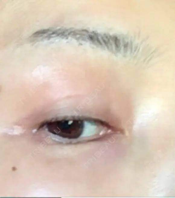 眉下切開 湘南美容クリニック 秋葉原院 DAY 918 メイン用