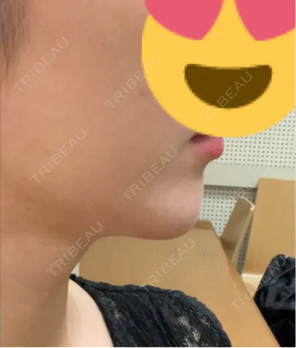 ヒアルロン酸注入（あご） Tokyo Tensei Clinic 銀座院 DAY 8 メイン用