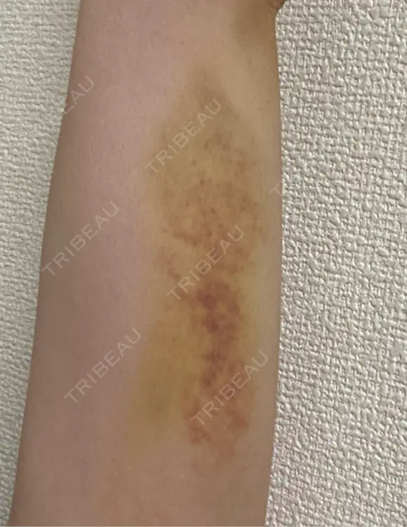 脂肪冷却（二の腕） LE CLINIC DAY 7 メイン用