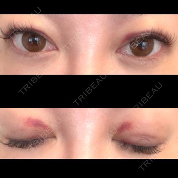 二重埋没 / 上まぶたの脂肪取り ROOTS Clinic DAY 13 メイン用