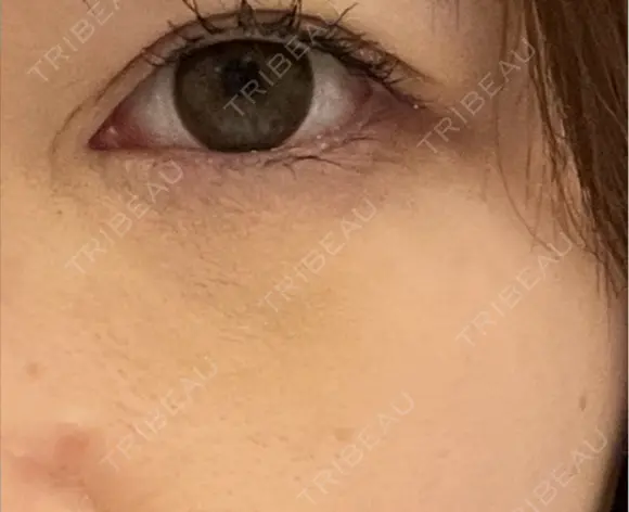 クマ治療 みずほクリニック DAY 3 メイン用