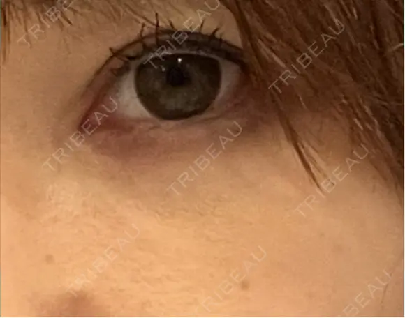 クマ治療 みずほクリニック DAY 17 メイン用