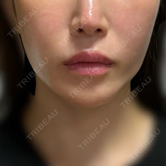 糸リフト / バッカルファット除去 / 脂肪吸引（顔） / ジョールファット除去 BLINC CLINIC （ブリンク クリニック） DAY 49 メイン用