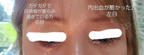ヒアルロン酸注入（涙袋） ビスポーククリニック 東京院 AFTER メイン用