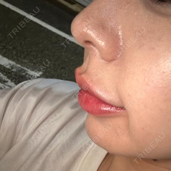 ヒアルロン酸注入（唇） Code Beauty Clinic 名古屋院 DAY 0 メイン用