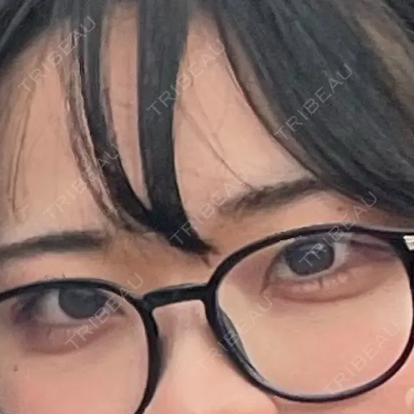ヒアルロン酸注入（涙袋） Code Beauty Clinic 名古屋院 DAY 1 メイン用