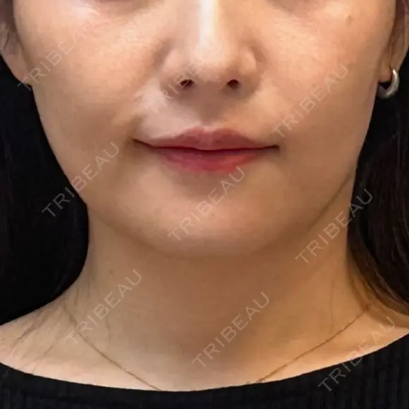 その他（輪郭） 表参道メディカルクリニック 銀座院 AFTER メイン用