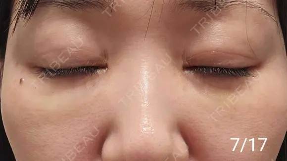 スネコス REVO CLINIC PLUS DAY 11 メイン用