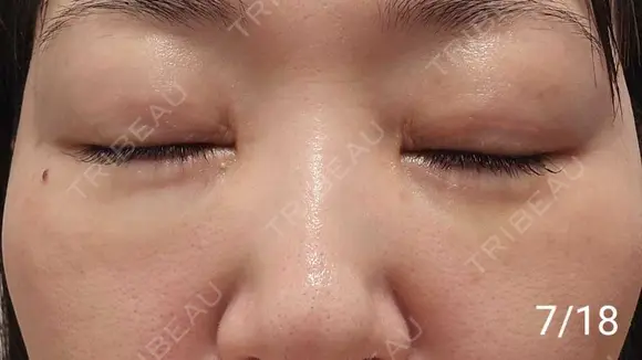 スネコス REVO CLINIC PLUS DAY 12 メイン用