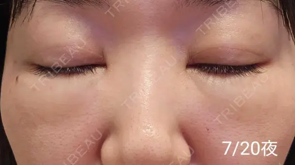 スネコス REVO CLINIC PLUS DAY 14 メイン用