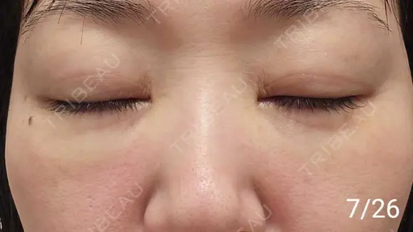 スネコス REVO CLINIC PLUS DAY 20 メイン用