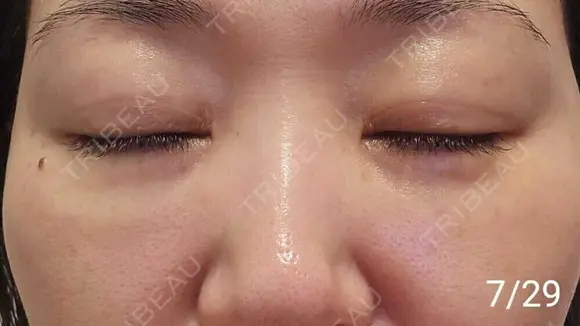 スネコス REVO CLINIC PLUS AFTER メイン用