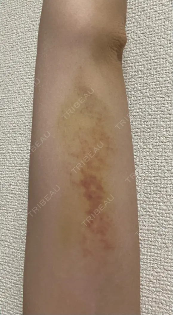 脂肪冷却（二の腕） LE CLINIC DAY 8 メイン用