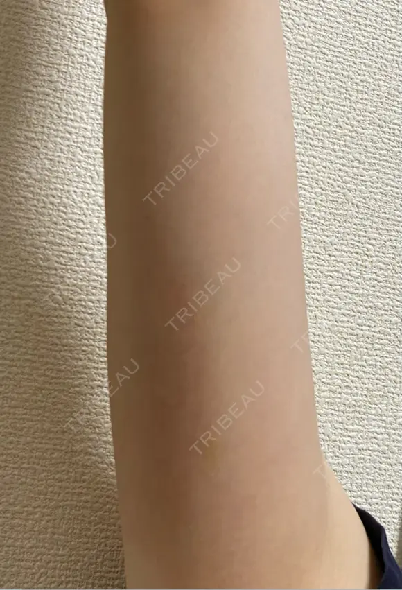 脂肪冷却（二の腕） LE CLINIC DAY 8 メイン用