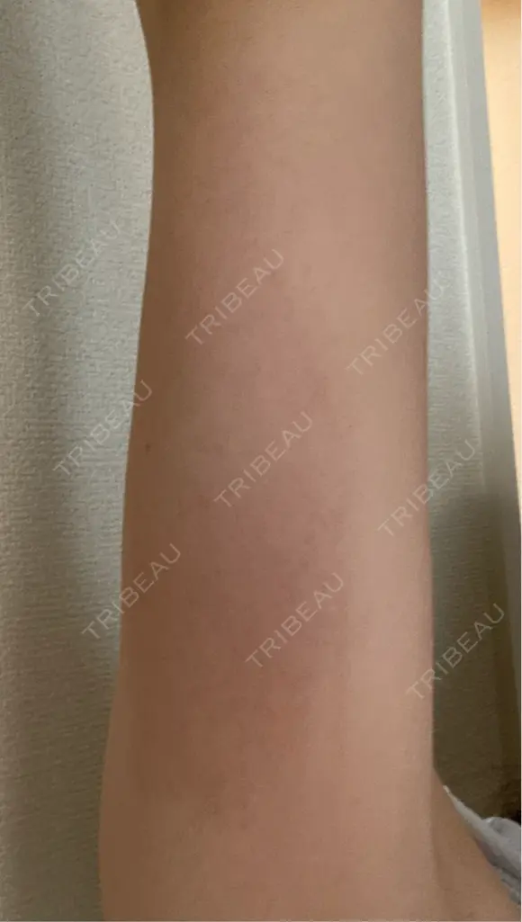 脂肪冷却（二の腕） LE CLINIC DAY 11 メイン用