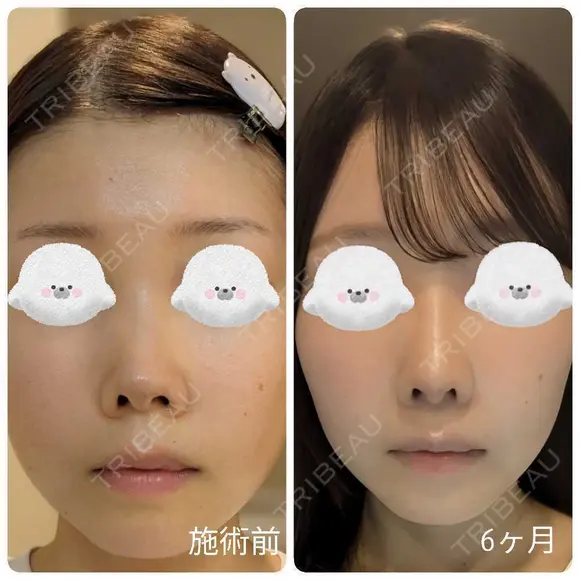 隆鼻術 / 鼻尖形成（切開） / 小鼻縮小（切開） / 軟骨移植 / 鼻柱下降・鼻唇角形成（猫手術） / ボトックス（エラ・小顔） / 毛穴洗浄（ハイドラフェイシャルなど） グローバルビューティークリニック 大阪院 AFTER メイン用