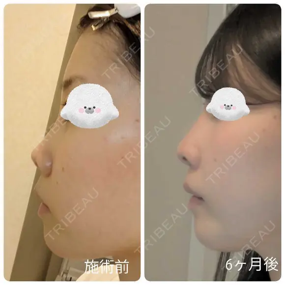 隆鼻術 / 鼻尖形成（切開） / 小鼻縮小（切開） / 軟骨移植 / 鼻柱下降・鼻唇角形成（猫手術） / ボトックス（エラ・小顔） / 毛穴洗浄（ハイドラフェイシャルなど） グローバルビューティークリニック 大阪院 DAY 181 メイン用