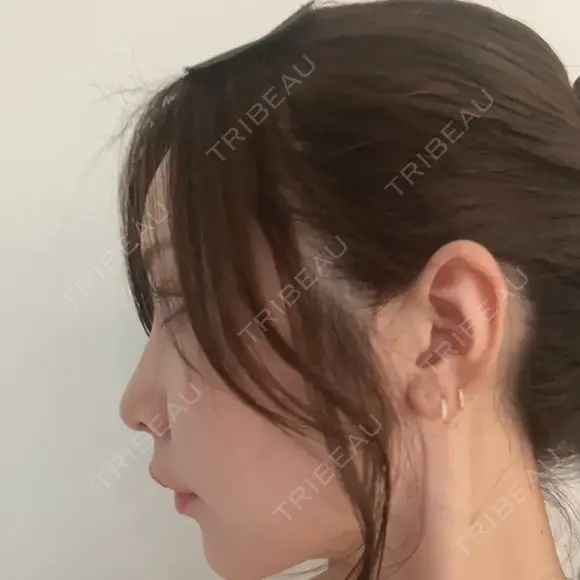 ヒアルロン酸注入（鼻） / ヒアルロン酸注入（唇） / ヒアルロン酸注入（頬） / ヒアルロン酸注入（こめかみ） BIANCA銀座 DAY 3 メイン用