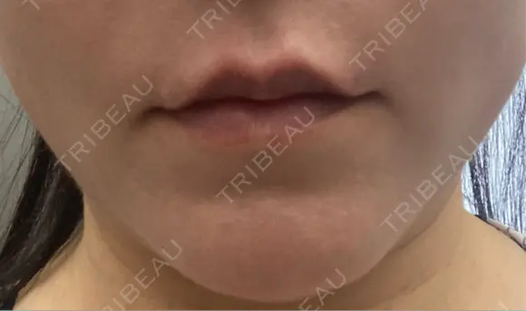 ボトックス（人中） BON BON CLINIC 銀座駅前本院 DAY 0 メイン用