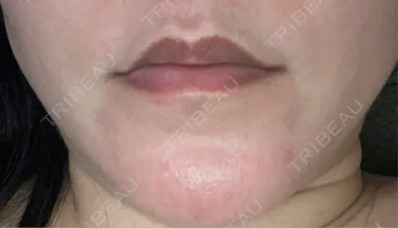 ボトックス（人中） BON BON CLINIC 銀座駅前本院 DAY 1 メイン用