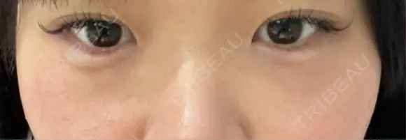 ヒアルロン酸溶解 Code Beauty Clinic 名古屋院 DAY 0 メイン用