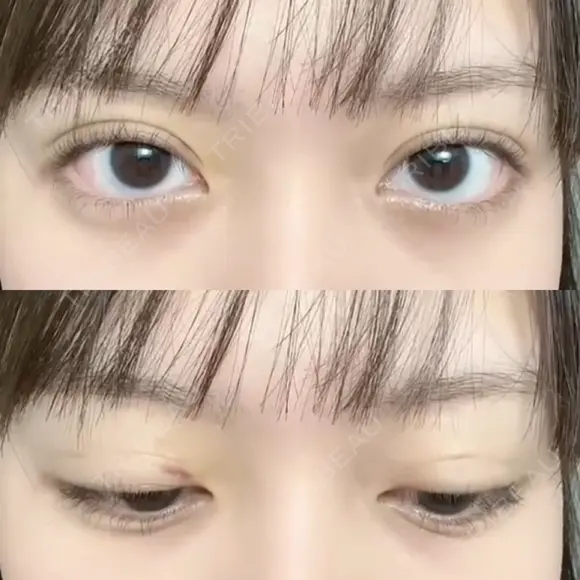二重埋没 湘南美容クリニック 博多院 DAY 5 メイン用
