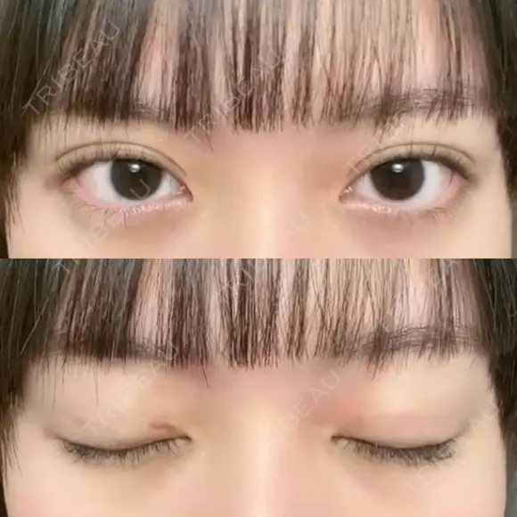 二重埋没 湘南美容クリニック 博多院 AFTER メイン用