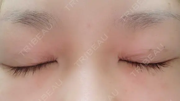 二重埋没 アリエル美容クリニック 郡山院 DAY 22 メイン用