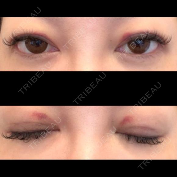二重埋没 / 上まぶたの脂肪取り ROOTS Clinic AFTER メイン用