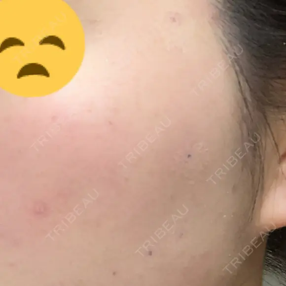 ほくろ・いぼ切除（肌） リメイ皮膚科 AFTER メイン用